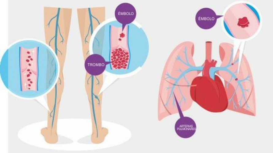 Infografías sobre la trombosis. ARCHIVO