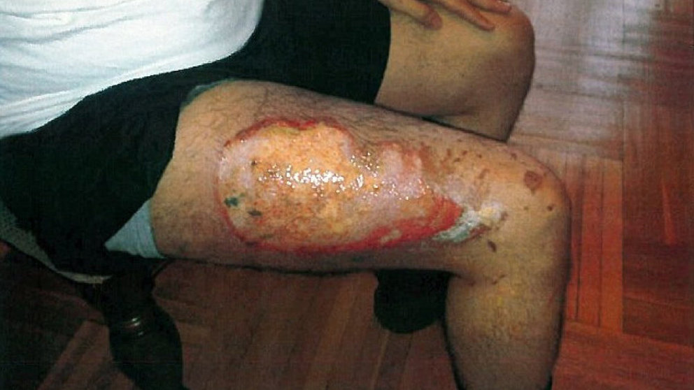 Imagen de la herida provocada en la pierna de un hombre al explotarle un cigarrillo electrónico Abogados Rubenstein and Drynecki
