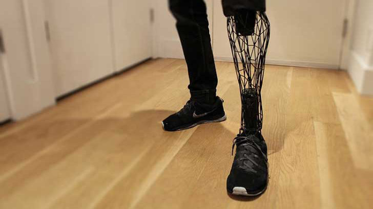Imagen de la prótesis implantada tras la amputación de una pierna ARCHIVO