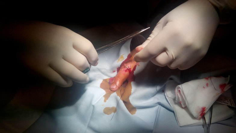 Un médico aplica varios puntos de sutura a una persona herida en una mano ARCHIVO