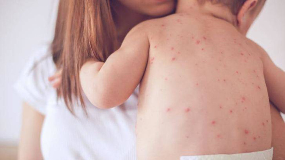 Una enfermera sostiene a un niño que ha sufrido un contagio de sarampión ARCHIVO