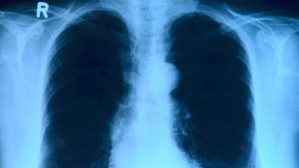 Una radiografía de unos pulmones. ARCHIVO