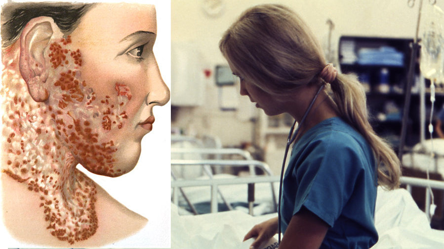 Imagen de un gráfico mostrando un episodio de lupus cutáneo junto a una enfermera trabajando en un hospital ARCHIVO