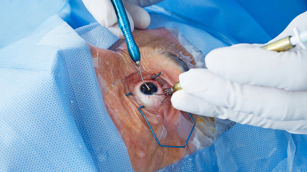 Intervención en la retina a un paciente operado por la pérdida de visión. ARCHIVO