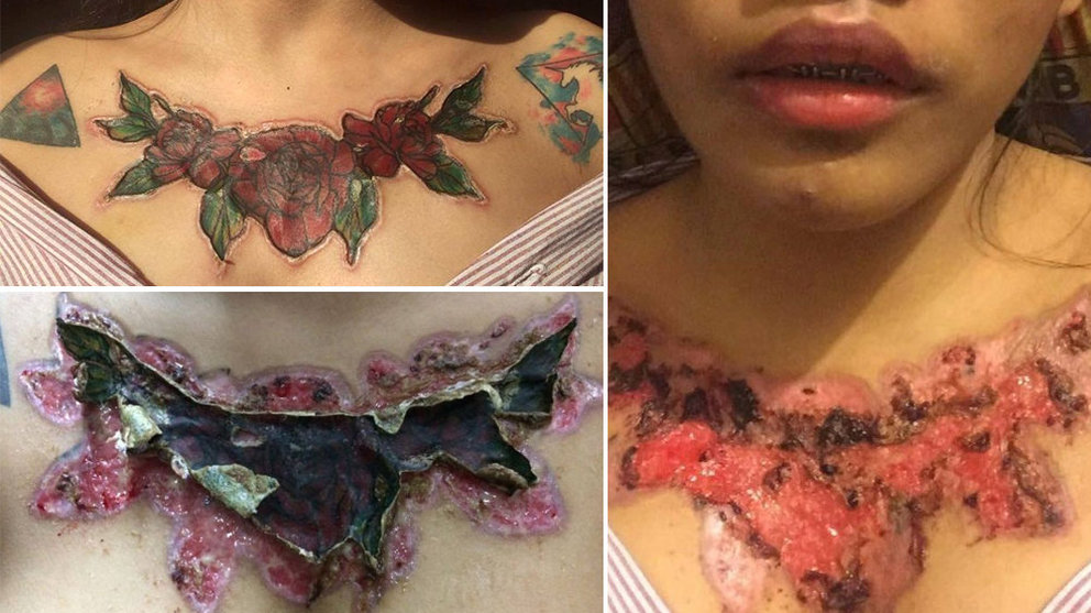 Imágenes de la joven tailandesa que se ha abrasado la piel tratando de retirarse por su cuenta un tatuaje en el pecho FACEBOOK