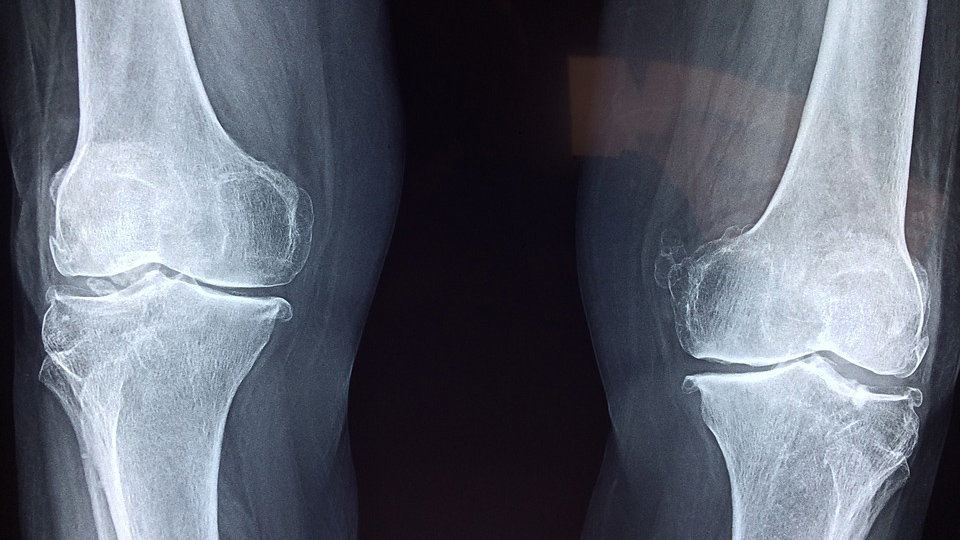 Imagen de la radiografía de una rodilla. ARCHIVO