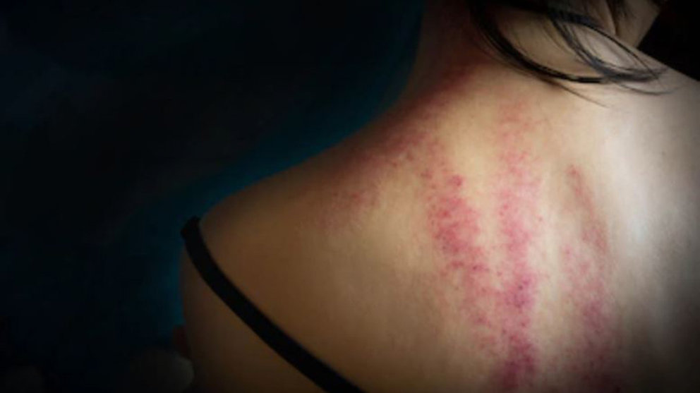 Imagen de una mujer con varios moratones en la espalda a consecuencia de una agresión sufrida. ARCHIVO