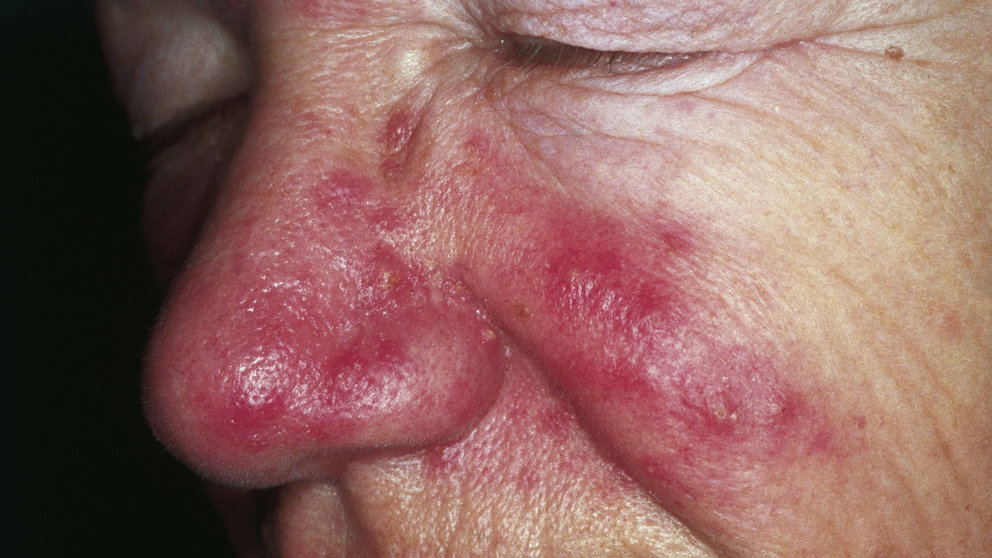 Imagen de una mujer afectada por la rosácea. ARCHIVO